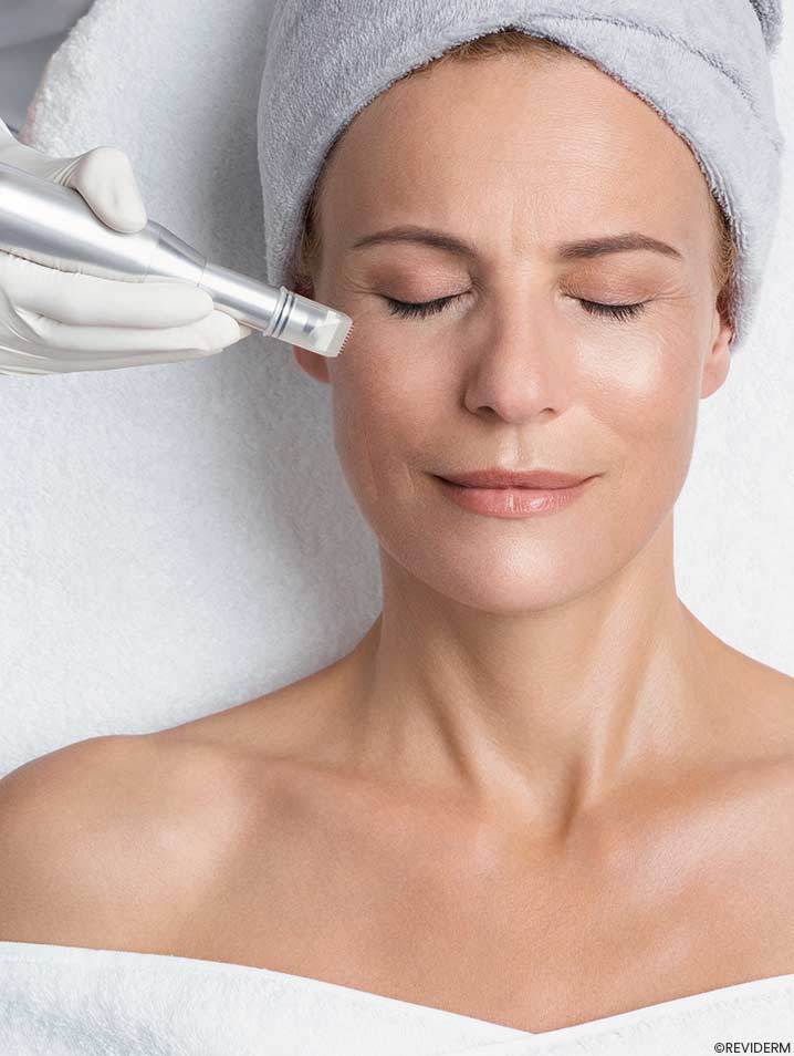 micro-needling behandlung